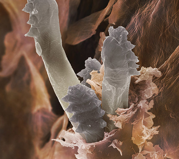 Demodex-heads
